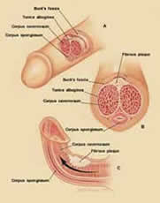 Induratio penis plastica (IPP)